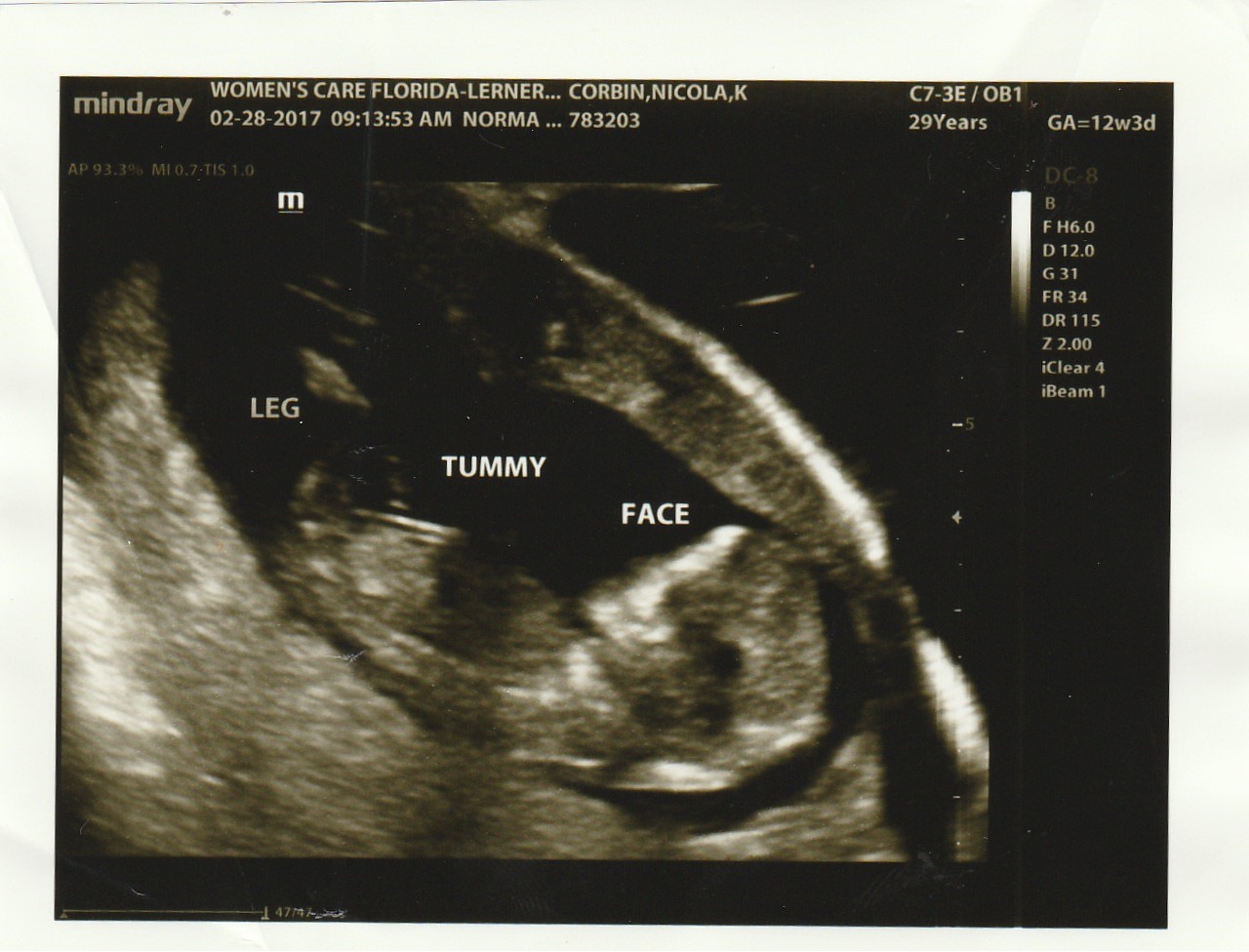 fetal heartbeat 12 weeks